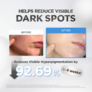 کاهش لک و تیرگی پوست با آمپول روشن‌کننده سنتلا SKIN1004